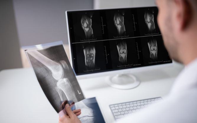 Resultados informados por pacientes del ácido hialurónico intraarticular para la osteoartritis de la rodilla: una serie de casos prospectiva y multicéntrica.