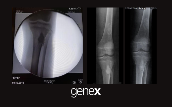 Caso clínico aplicación de genx en defecto óseo de tibia proximal – Dr. Julio Carlos Vélez de Lachica
