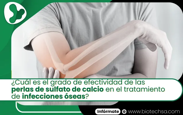 El uso de STIMULAN- Sulfato de Calcio en infecciones de hueso y articulaciones