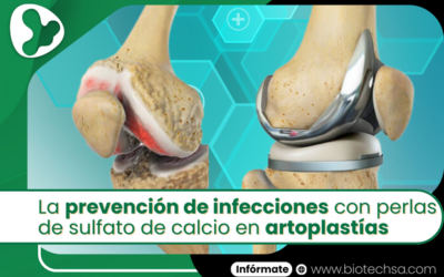 La prevención de infecciones con perlas de sulfato de calcio en artoplastías
