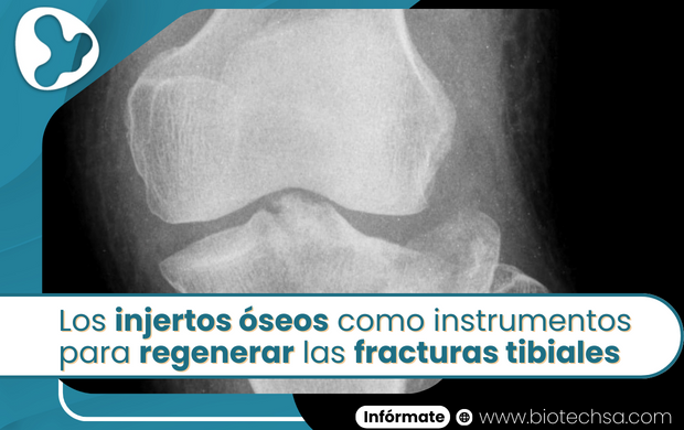 Los injertos óseos como instrumentos para regenerar las fracturas tibiales
