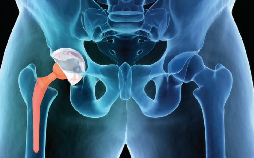 Disminución de la incidencia de infecciones articulares periprotésicas agudas con microesferas de sulfato de calcio cargadas con vancomicina en pacientes con factores de riesgo no modificables. Un ensayo clínico aleatorizado