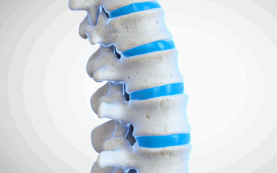 Manejo preventivo de la vértebra sándwich: una estrategia eficaz en osteoporosis avanzada