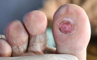 Esferas de sulfato de calcio con antibióticos en el tratamiento de infecciones del pie diabético