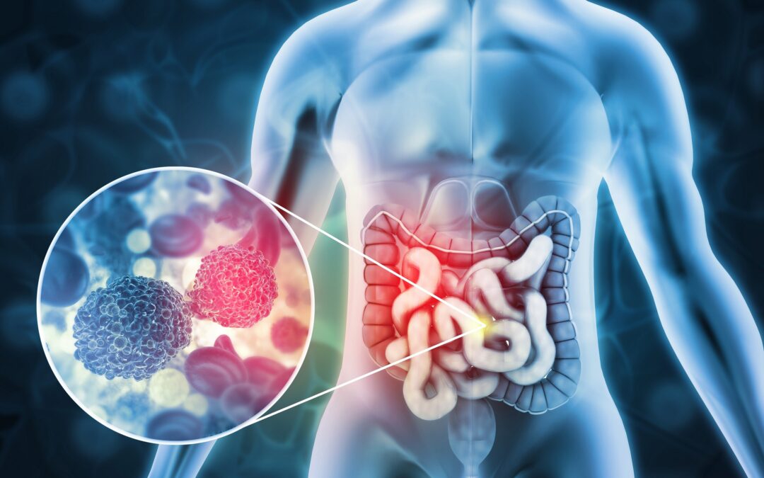 Cáncer colorrectal al alza: los alimentos ultraprocesados en el centro de la discusión 
