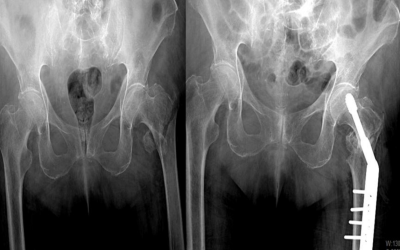 El poder de GeneX (β-TCP/CaSO₄) para tratar fracturas de cadera inestables