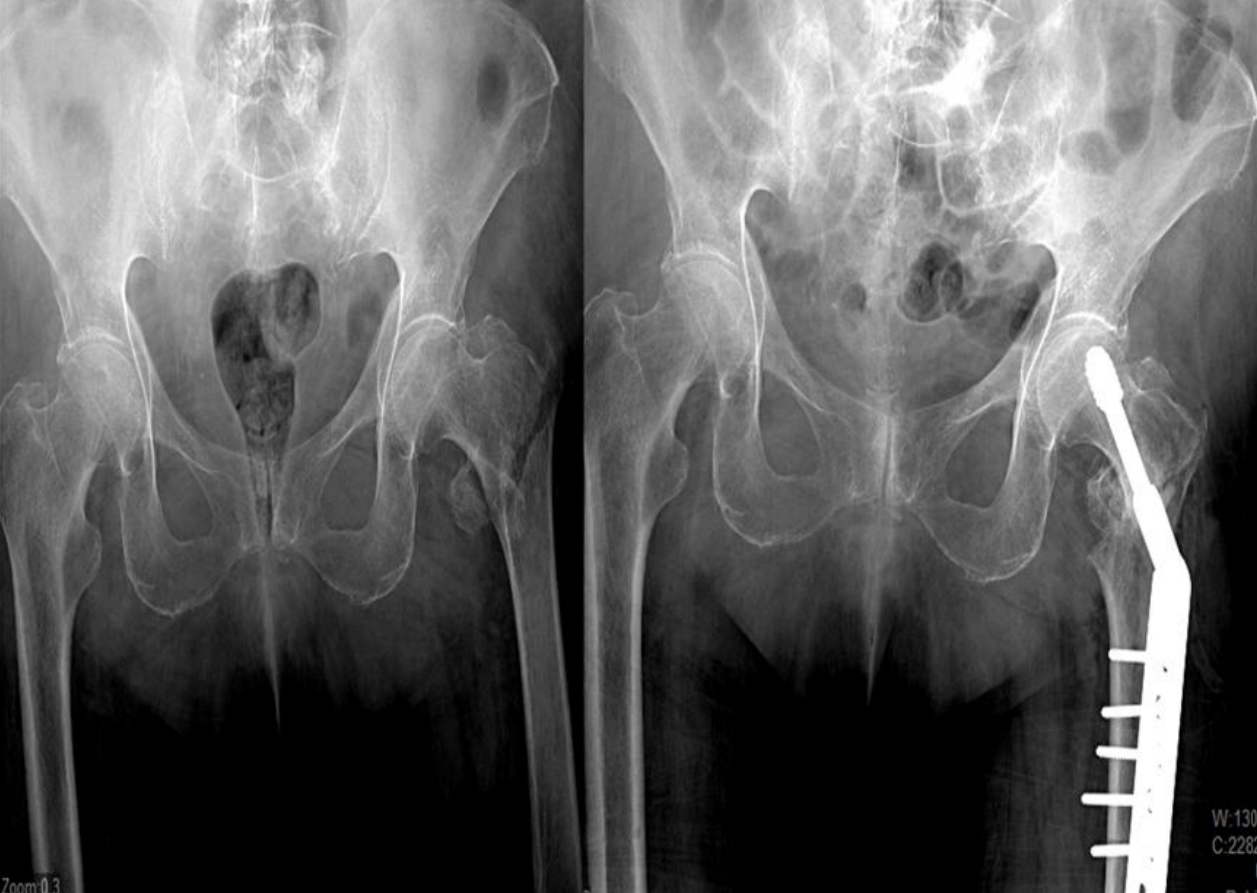 El poder de GeneX (β-TCP/CaSO₄) para tratar fracturas de cadera inestables