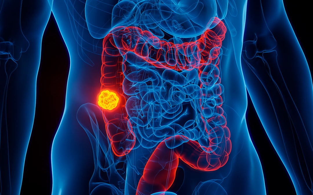 Cáncer colorrectal al alza: los alimentos ultraprocesados en el centro de la discusión 