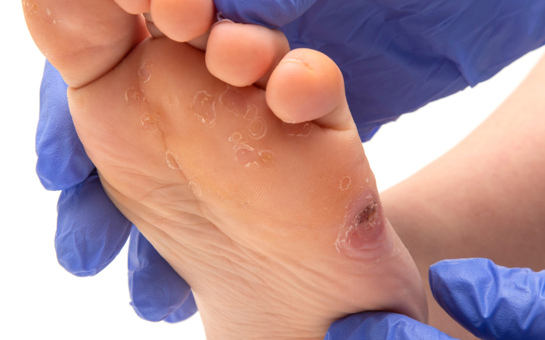 Alerta global: una amputación por pie diabético cada 20 segundos