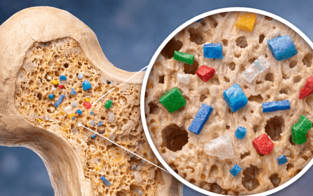 Microplásticos en el tejido óseo humano: un nuevo factor a considerar en la salud del sistema musculoesquelético