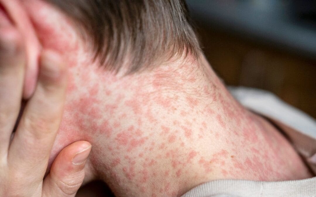 56% de los brotes de sarampión se concentran en Jalisco 