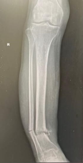 Tuberculosis tibia
