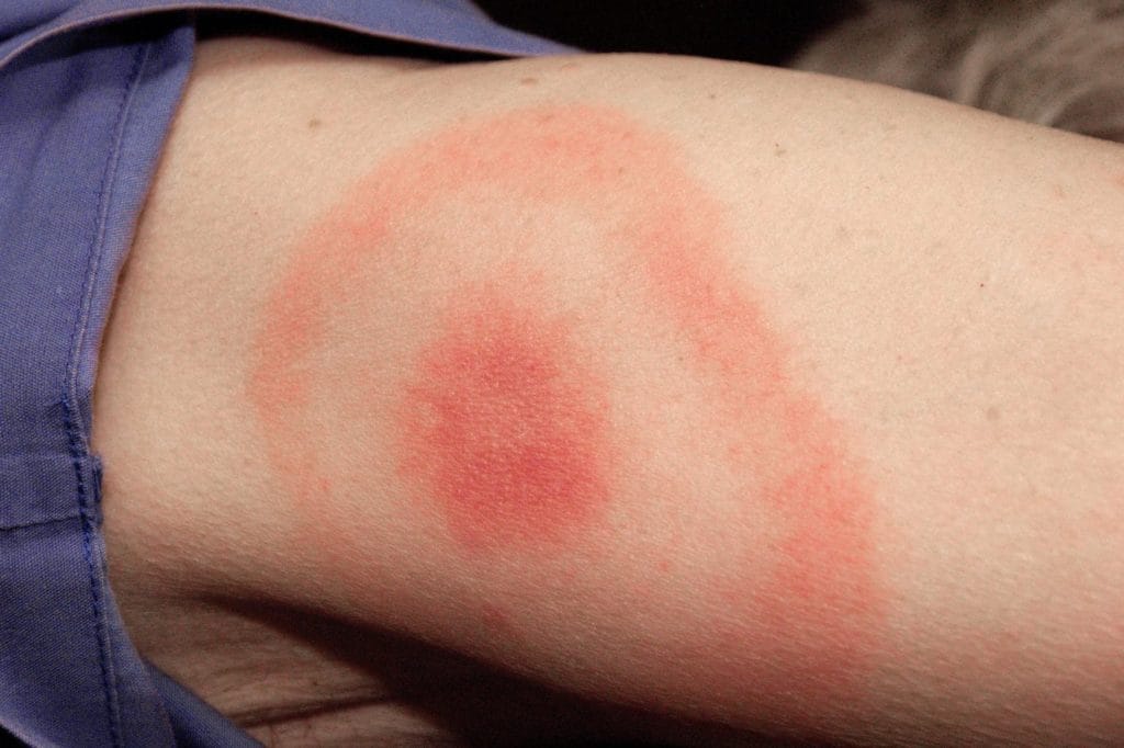 ¿Nueva vacuna contra la enfermedad de Lyme? Pfizer asegura eficacia superior a 70%