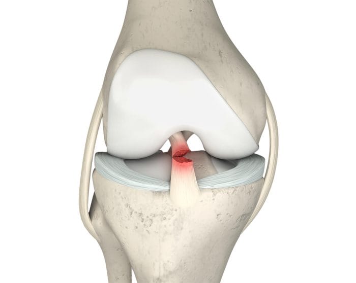 Ligamento Cruzado Anterior