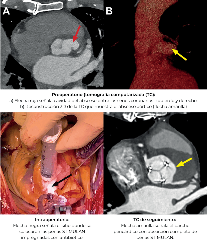 endocarditis infecciosa
