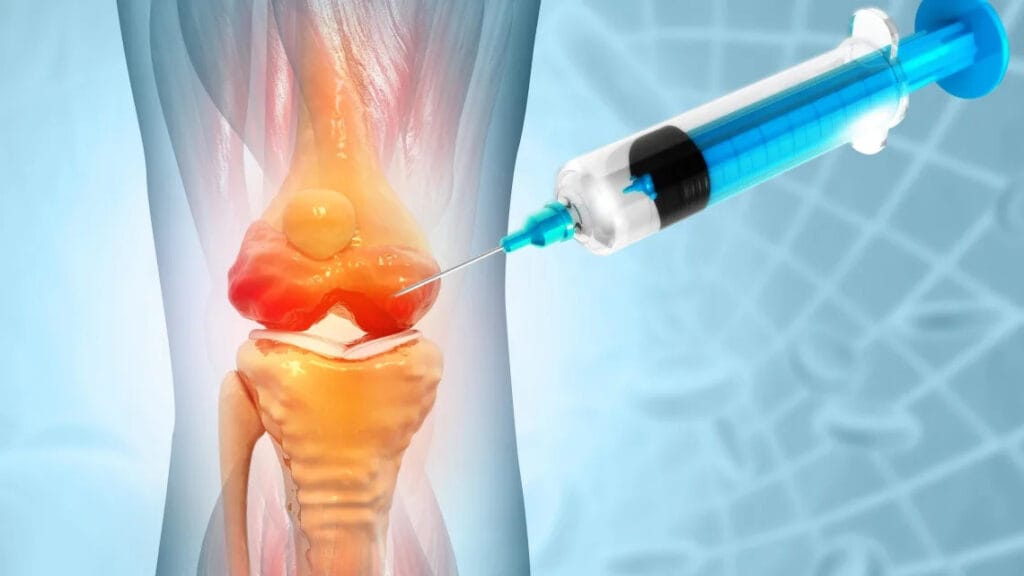 osteoartrosis de rodilla