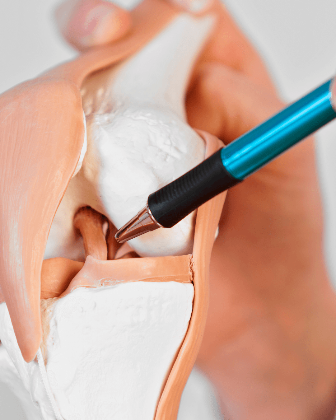 Ligamento Cruzado Anterior