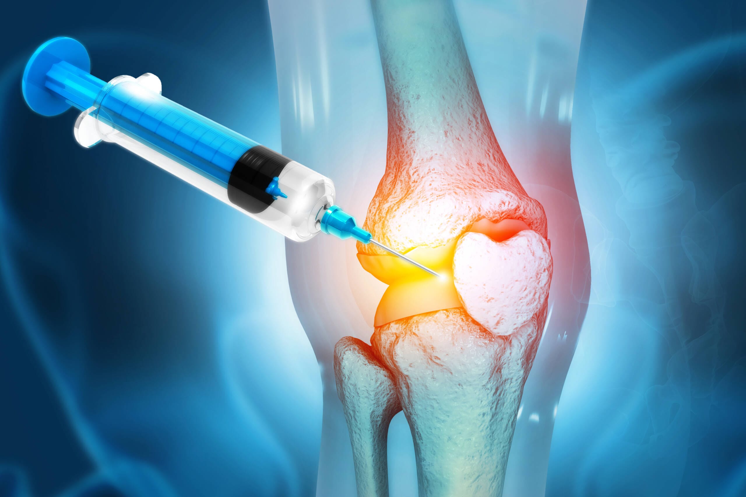 El valor de la viscosuplementación en el manejo integral de la osteoartrosis de rodilla