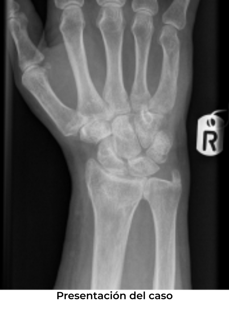radio distal