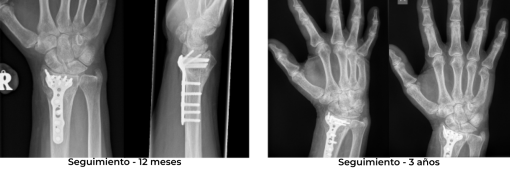 radio distal
