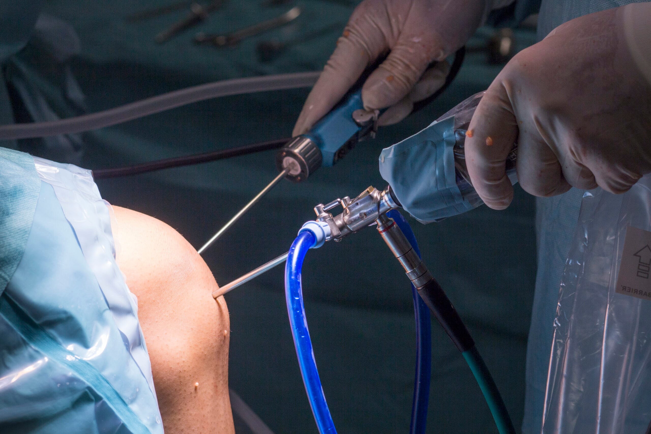 ¿Puede Synolis VA mejorar el dolor después de una artroscopia de rodilla?