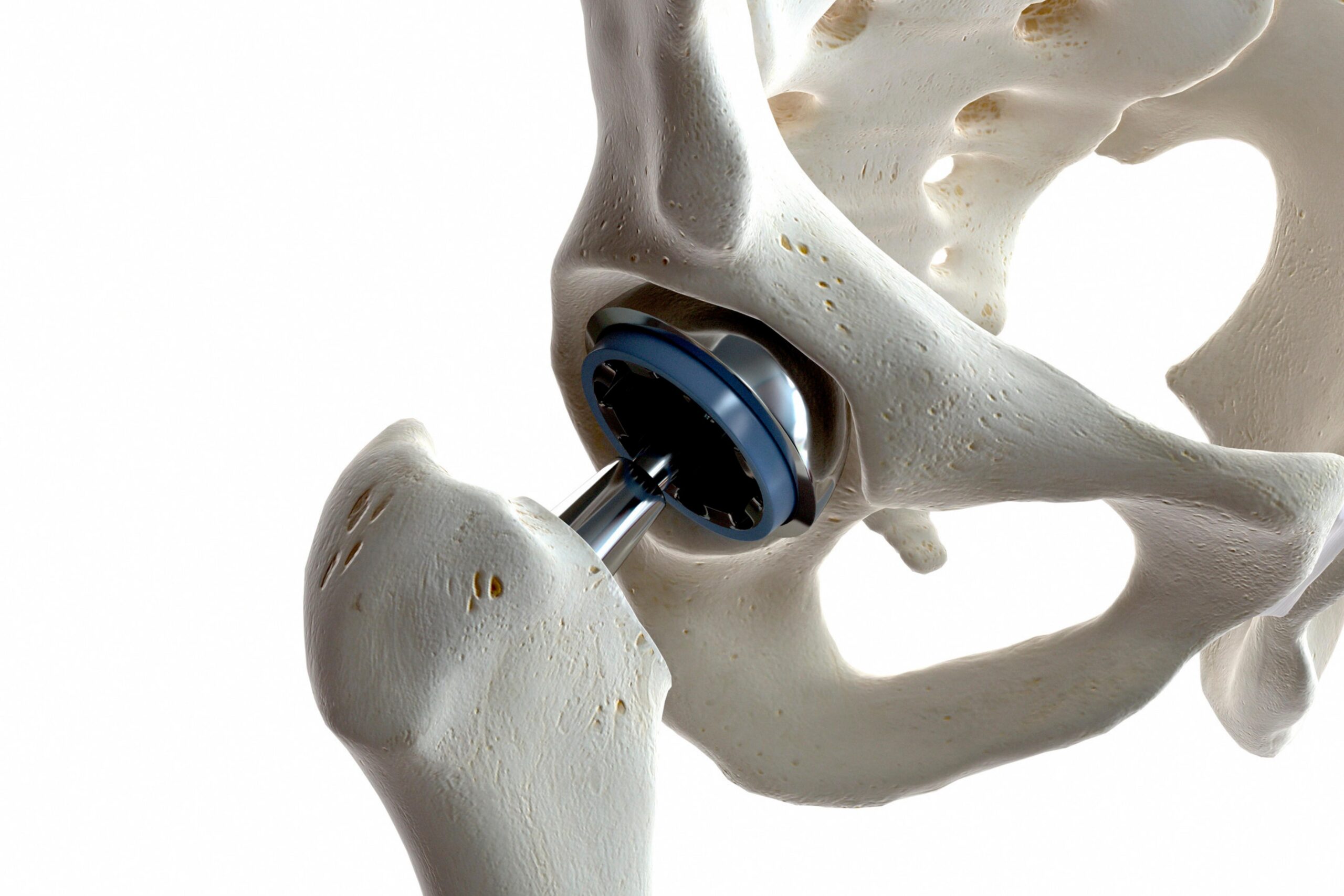 Uso profiláctico de STIMULAN en artroplastia total de cadera no cementada