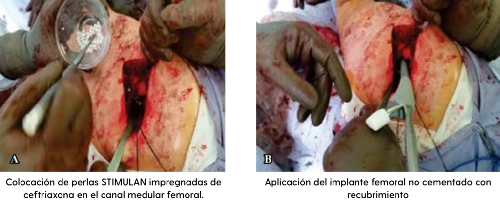 artroplastia total cementada
