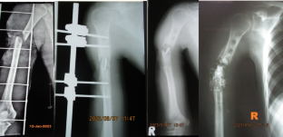 infecciones fracturas