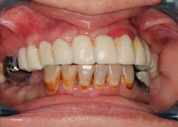 periodontitis
