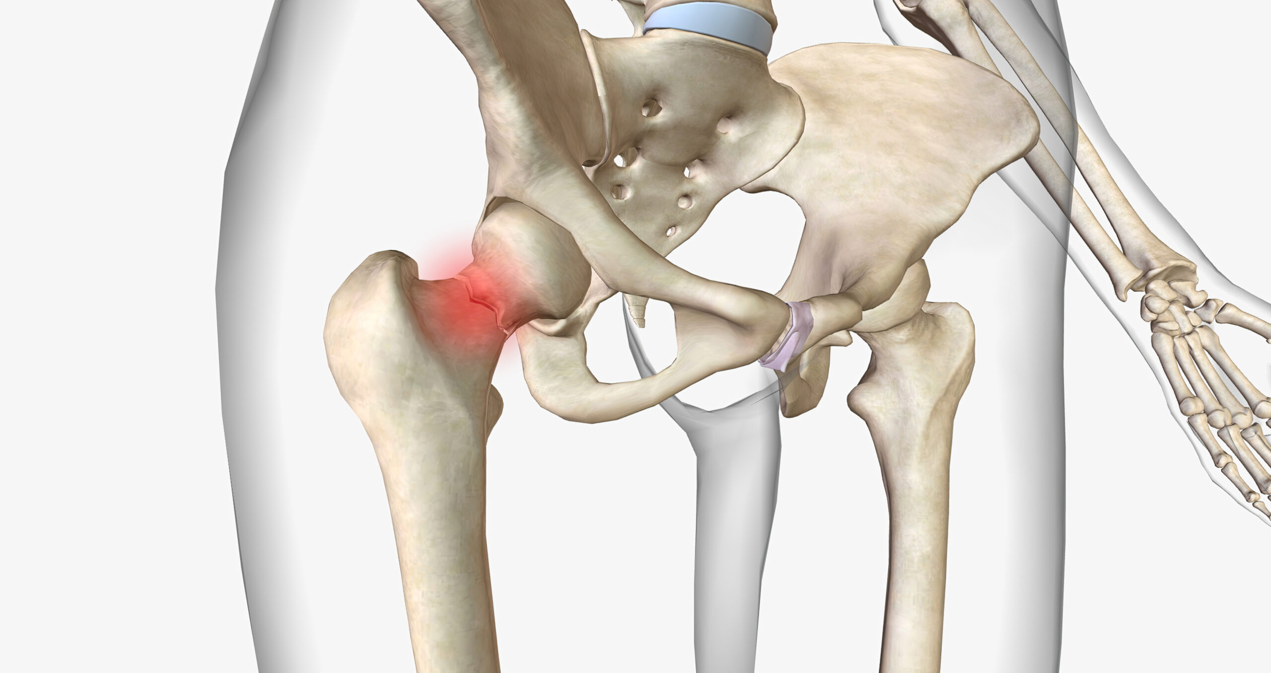 Fractura intertrocantérica inestable por osteoporosis: evaluación de GENEX ds en la fijación intramedular